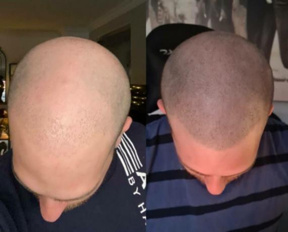 Scalp Micropigmentation: A Breakthrough Technique